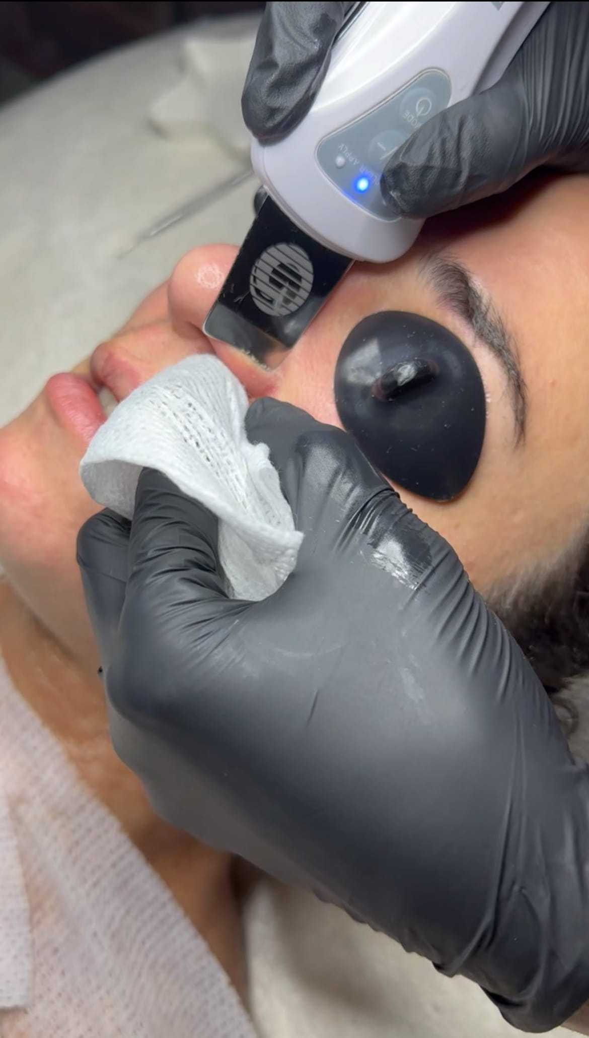 Skin treatment in progress with protective eyewear and gloved hands on the patient's face.